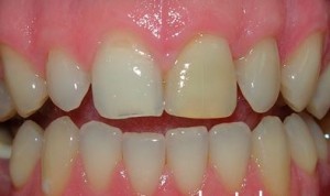 Photo: Assombrissement de l'émail de la dent avant après extension
