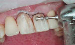 Photo: Préparation des dents pour les facettes