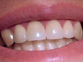 Photo: Restauration artistique des dents avec des facettes