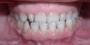 Mesial bite - what is it, photo, treatment, surgery, correction