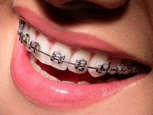 Photo: Appareil orthodontique pour le traitement de la malocclusion