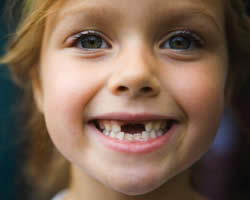 Photo: Changement permanent des dents de lait