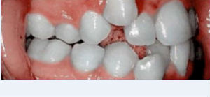 Photo: Descendance alvéolaire dentaire