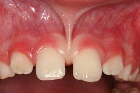 Photo: La présence d'un espace entre les dents
