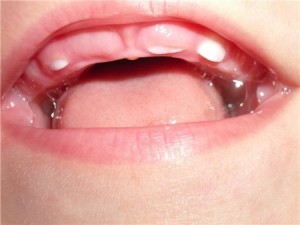 Photo: Trouble de la dentition