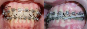 Photo: Traitement orthodontique avec arcs et élastique