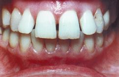 Photo: Dents avant l'occlusion