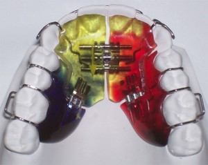 Photo: plaques d'alignement des dents amovibles