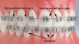 Photo: Correction des dents avec des accolades
