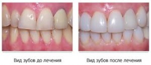 Photo: Dents avant et après restauration