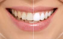 Photo: Dents avant et après blanchiment