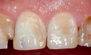 Photo: Érosion de l'émail des dents