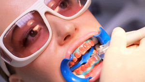 Photo: Procédure de blanchiment des dents au laser