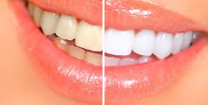 Photo: Avant et après le blanchiment des dents