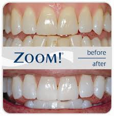 Photo: dents avant et après blanchiment zoom
