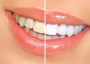 Photo: Dents avant et après blanchiment