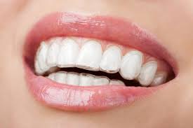 Photo: Blanchiment des dents avec un protège-dents