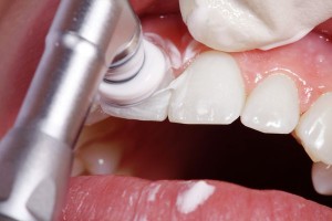 Photo: Fluoration des dents après blanchiment
